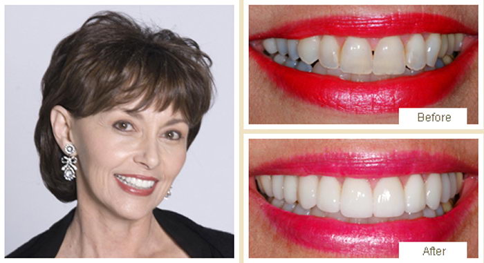 Before and after smile makeover showing brighter, straighter teeth