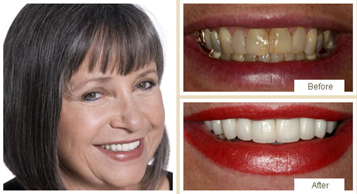 Cosmetic dentistry smile transformation with porcelain veneers
