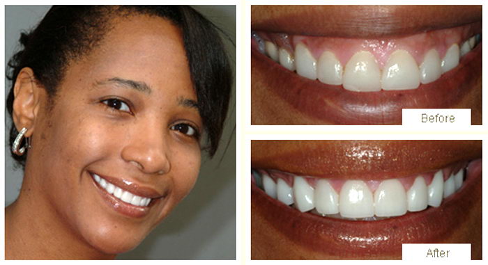 Close-up of smile makeover highlighting straight white teeth
