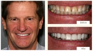 Dental veneer transformation creating a confident smile