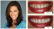 Smile enhancement using veneers and professional whitening