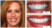 Patient smile makeover showing improved symmetry and brightness