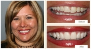 Cosmetic dentistry results featuring uniform, white teeth