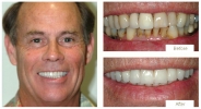 Beautiful smile makeover with natural-looking dental veneers