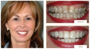 Teeth whitening and veneer transformation smile gallery image