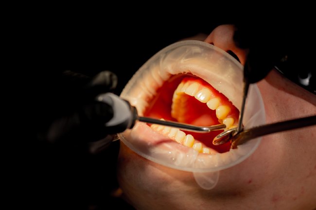 Treatment of Periodontal Disease