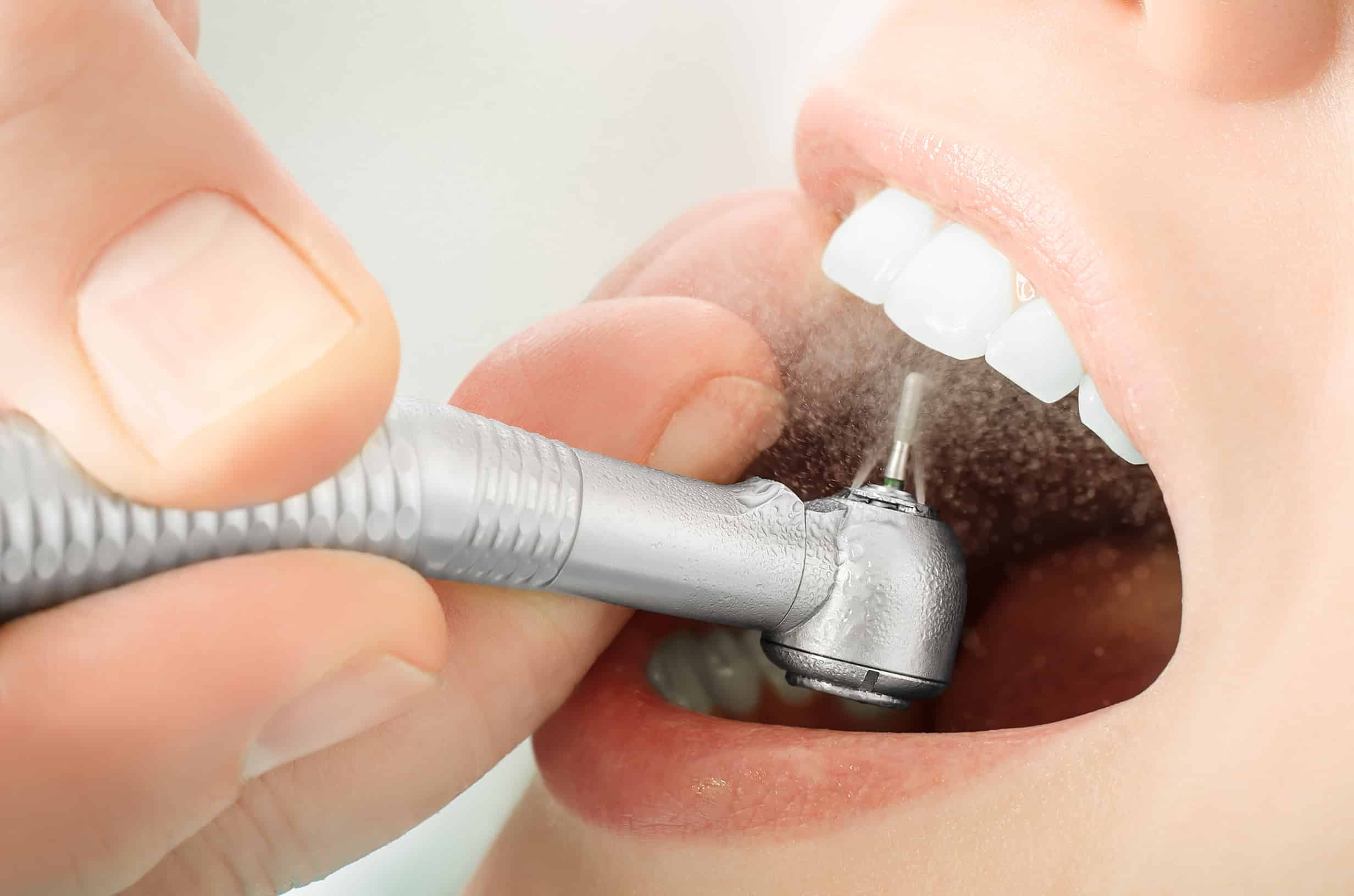 Types of Dental Restoration